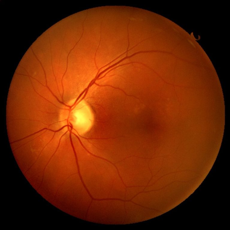 „Nahaufnahme einer gesunden menschlichen Netzhaut, aufgenommen mit einer Funduskamera. In der Mitte ist die gelblich helle Papille (Sehnerve