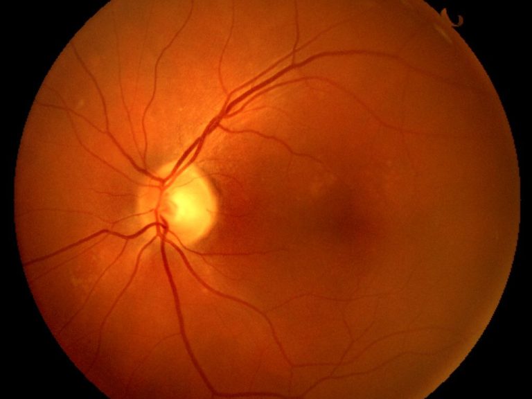 Netzhautanalyse und Netzhautscan – SehVia mobiler Optiker Leipzig